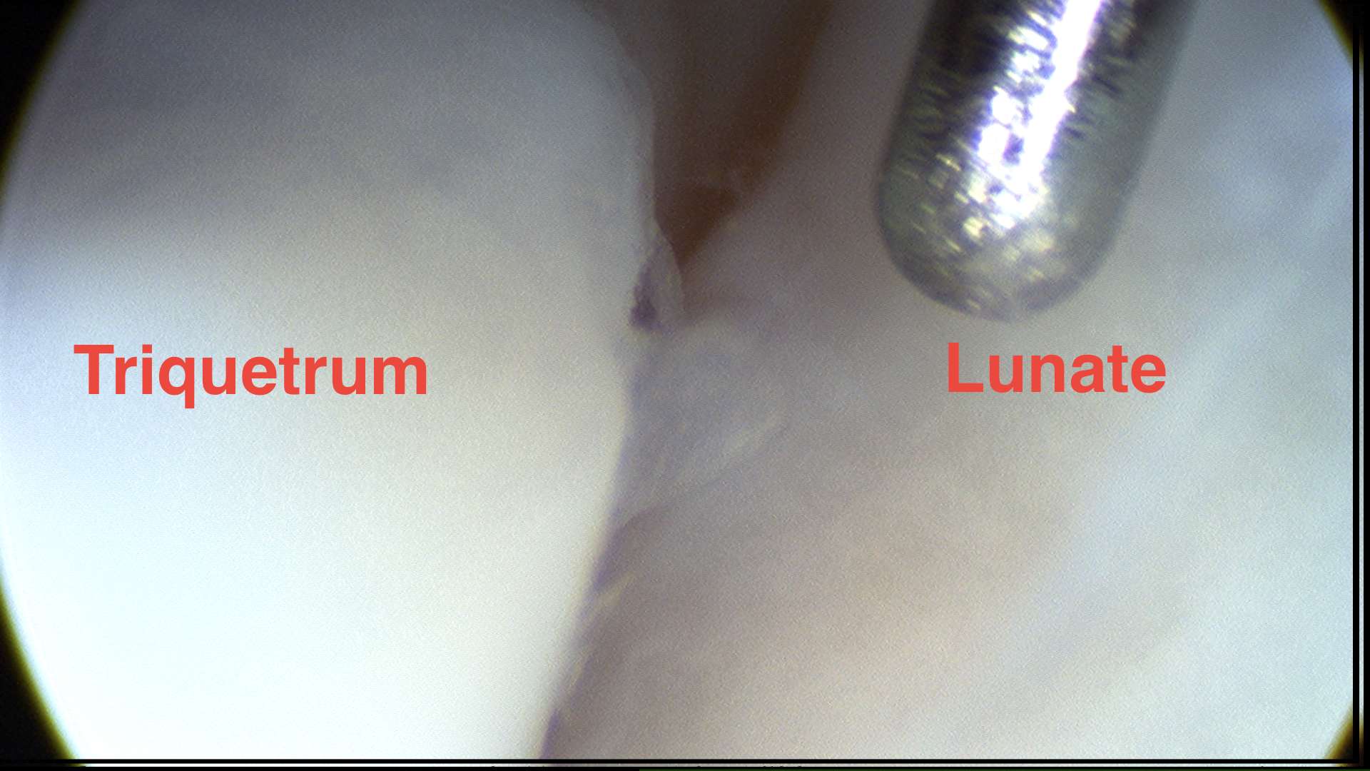 Wrist Scope Midcarpal Normal Lunate Triquetrum